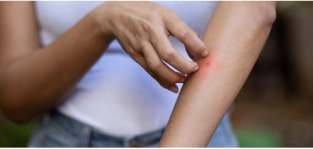 Prurito e gonfiore? 5 rimedi naturali per le punture di zanzara