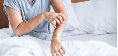Quali sono i sintomi dell'orticaria da stress e come si cura